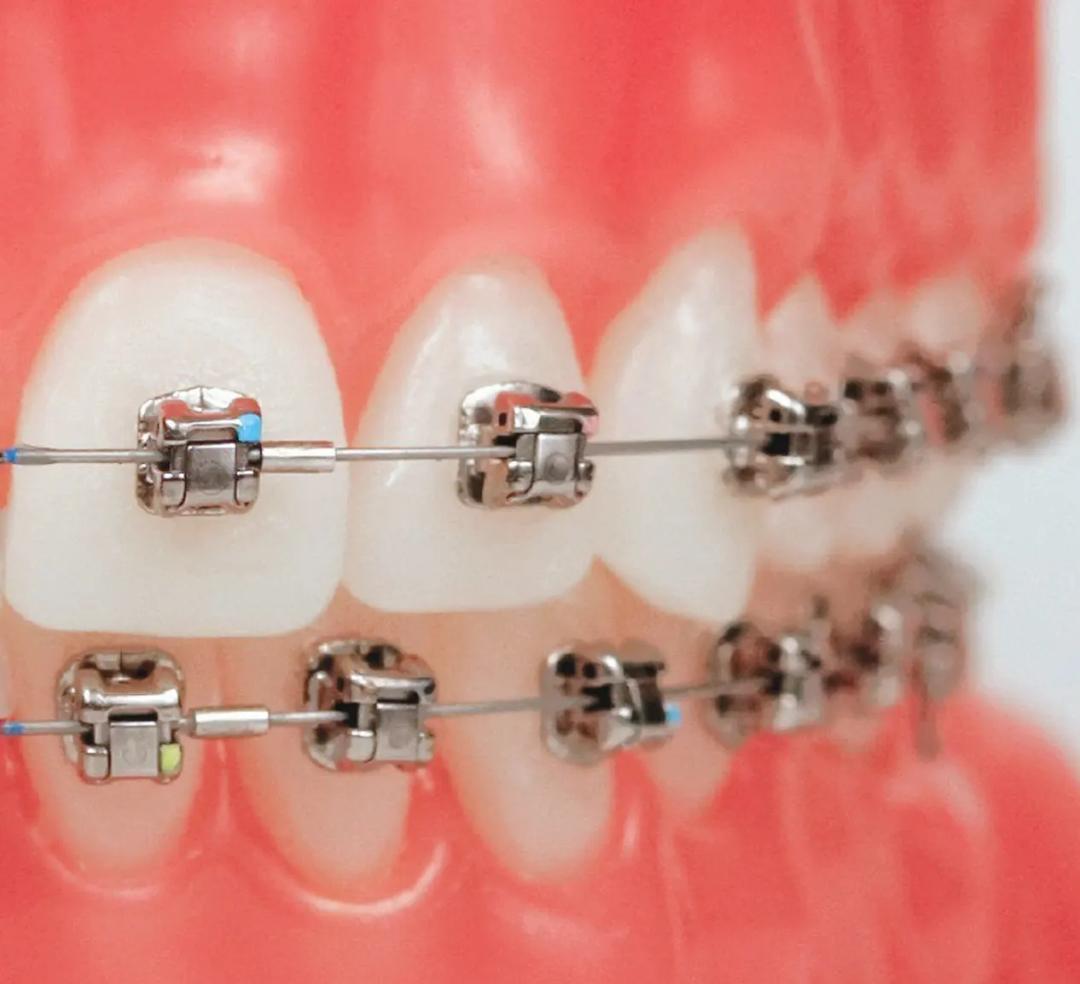 Damon Braces System for Orthodontic Treatment