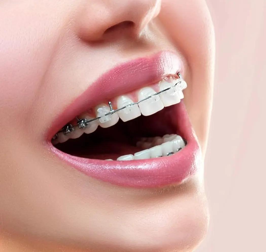 Orthodontist doctor performing treatment with ceramic braces