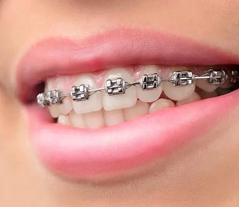 Orthodontist doctor performing treatment with metal braces