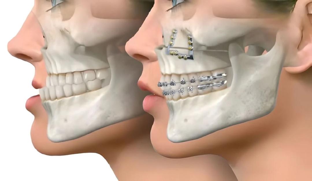 Surgeon performing orthognathic surgery to correct jaw and facial abnormalities.